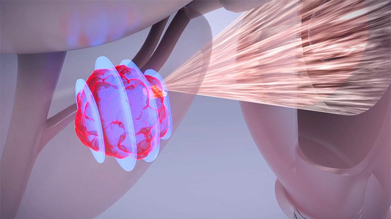 bioresonance therapy for cancer