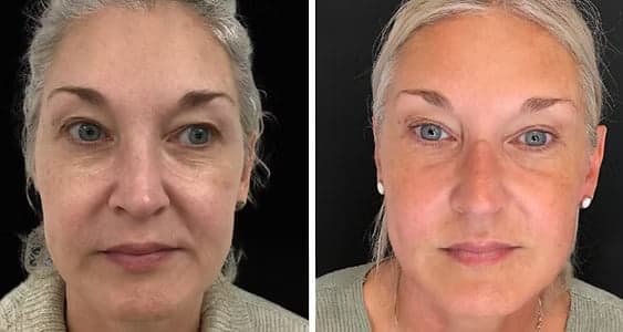 Radio Frequency Therapy Facial Tightening 1 radio frequency therapy face
