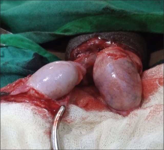 Testicular Torsion Medicine 1 testicular torsion medicine