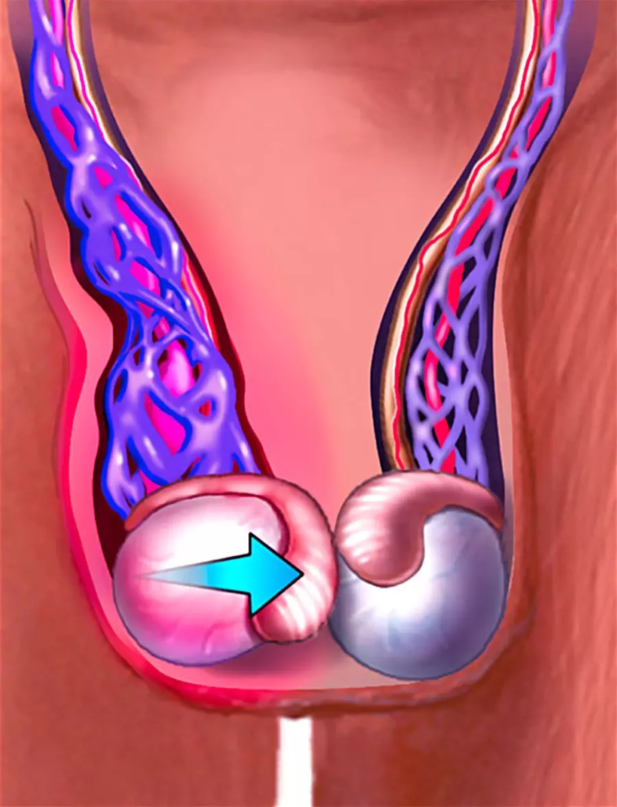 testicular torsion medicine